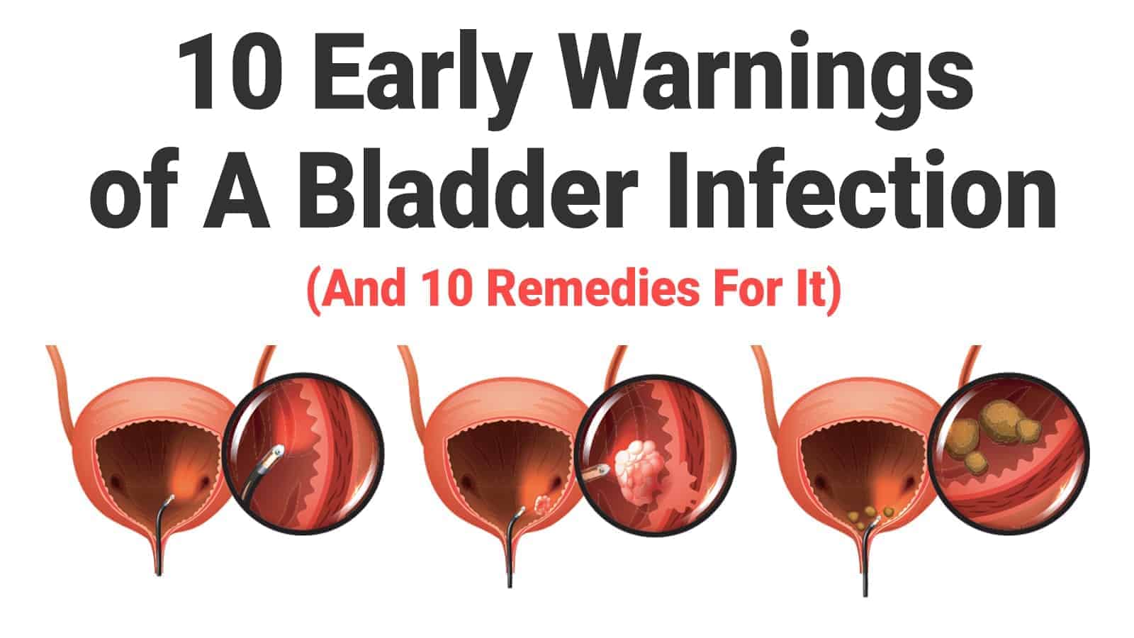 10 Early Warnings of A Bladder Infection (And 10 Remedies ...