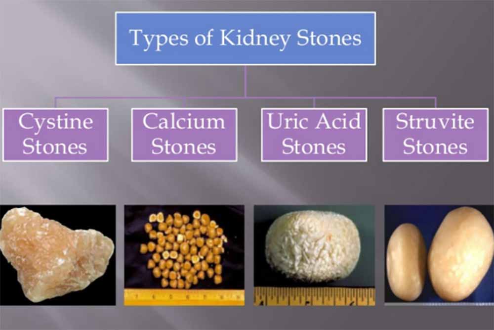 10 Kidney Stone Symptoms & 11 Home Remedies for Kidney Stones