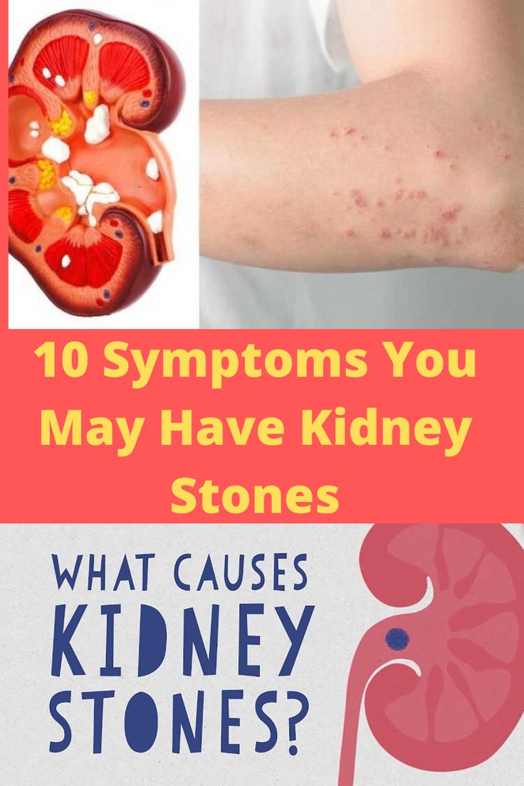10 Symptoms You May Have Kidney Stones in 2020