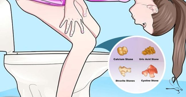 13 Unknown Warning Signs That Youâll Get Kidney Stones ...