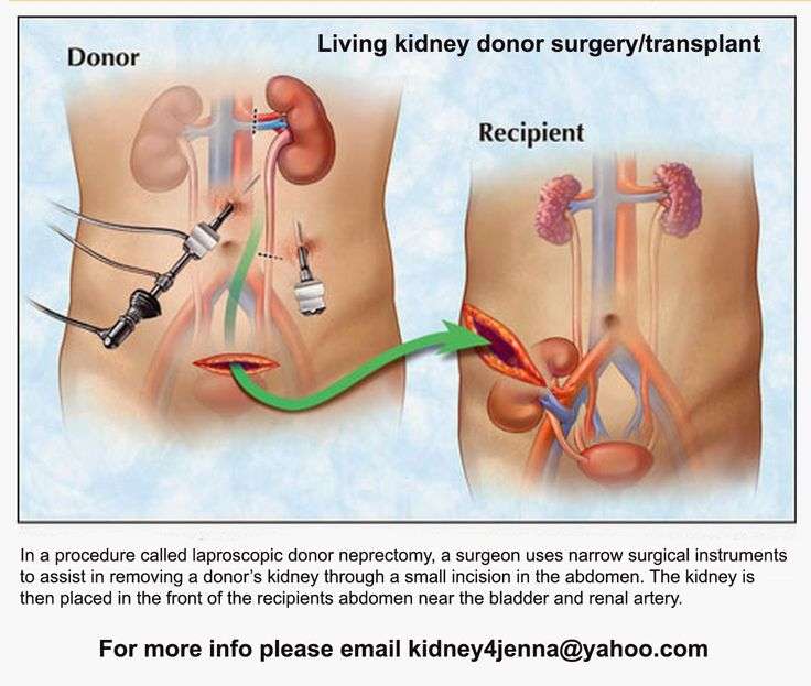 17 Best images about Living Kidney Donor on Pinterest