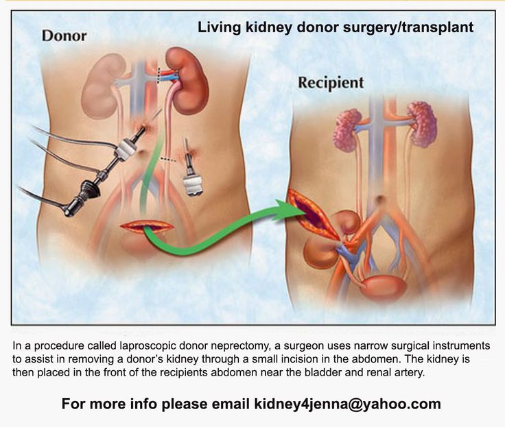 17 Best images about Living Kidney Donor on Pinterest ...