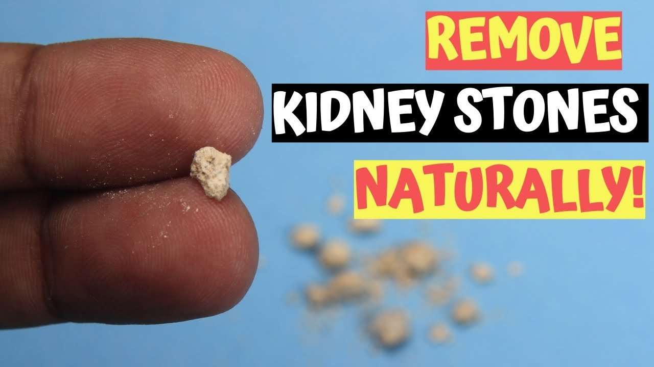 2 Best Remedies To Remove Kidney Stones Naturally In Men ...