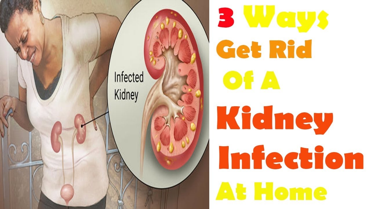 3 Ways To Get Rid Of A Kidney Infection At Home