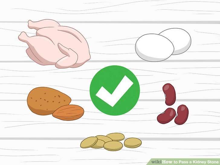 3 Ways to Pass a Kidney Stone