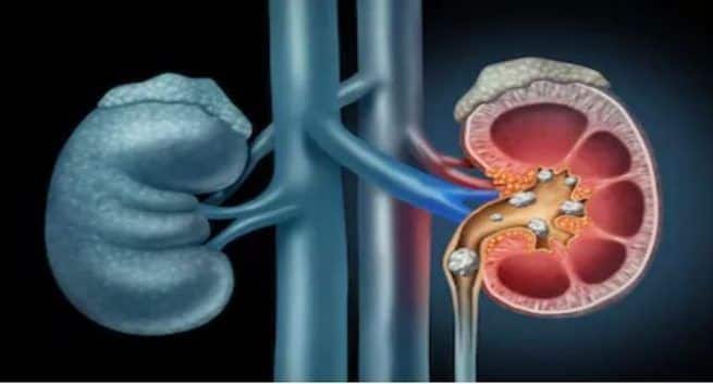 5 ways to dissolve kidney stones naturally