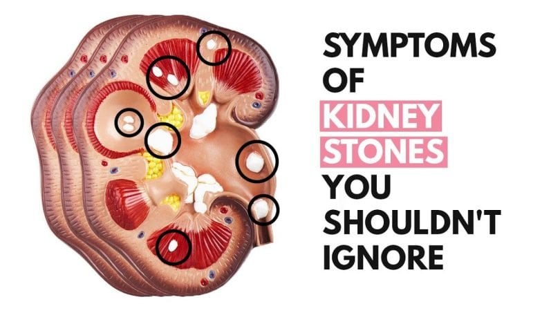 6 Symptoms Of Kidney Stones That You Might Not Be Paying ...