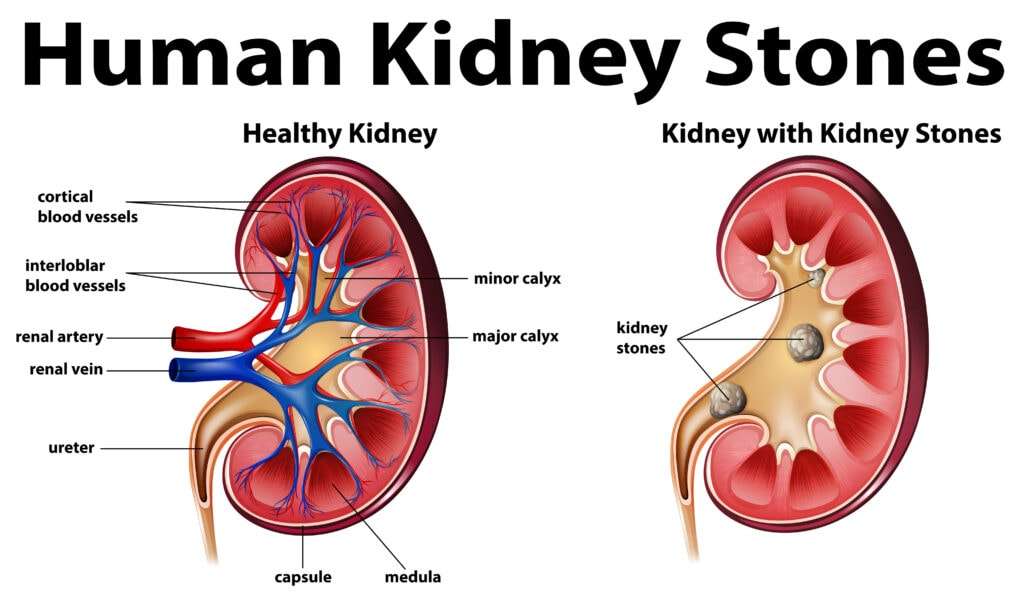 7 Quick Guide To Know What Is Kidney Stone Pain Like? â Turn To Be Healthy