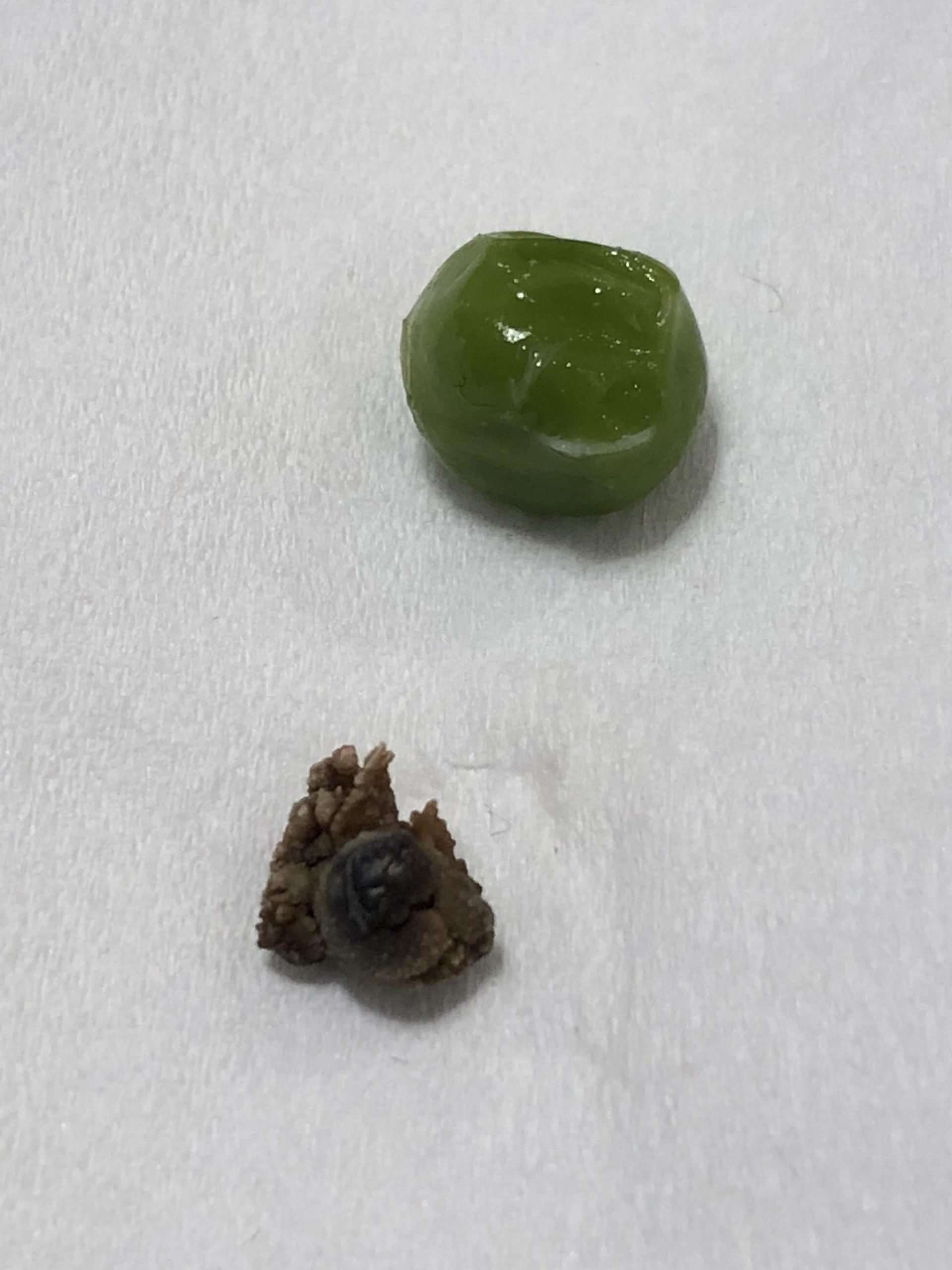 8 Millimeter 8mm Kidney Stone