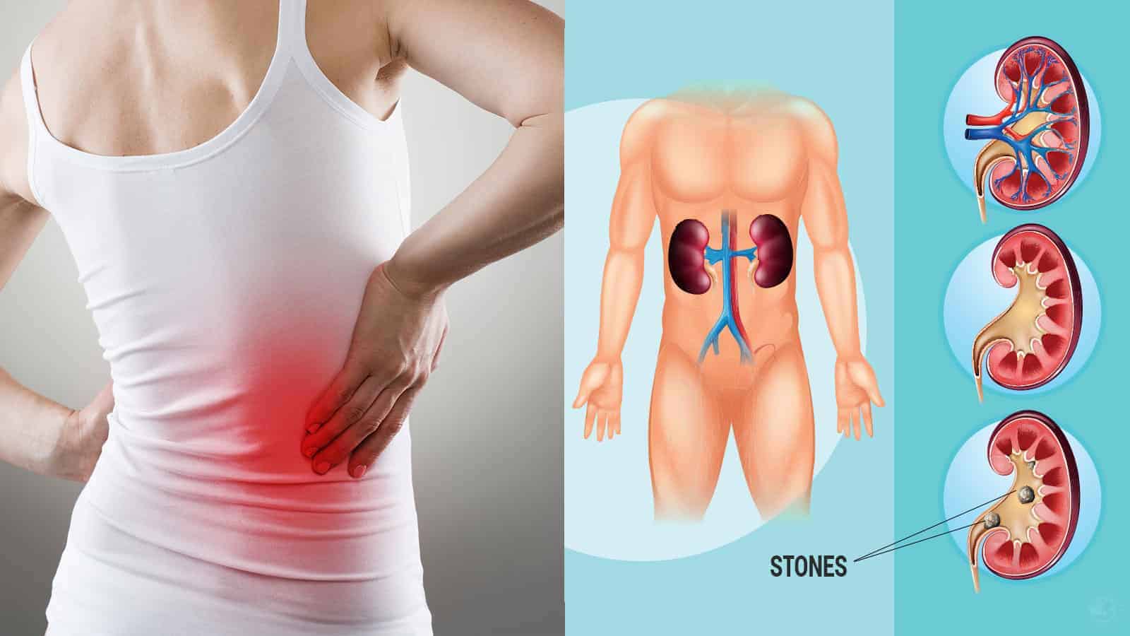 8 Symptoms of Kidney Stones to Never Ignore