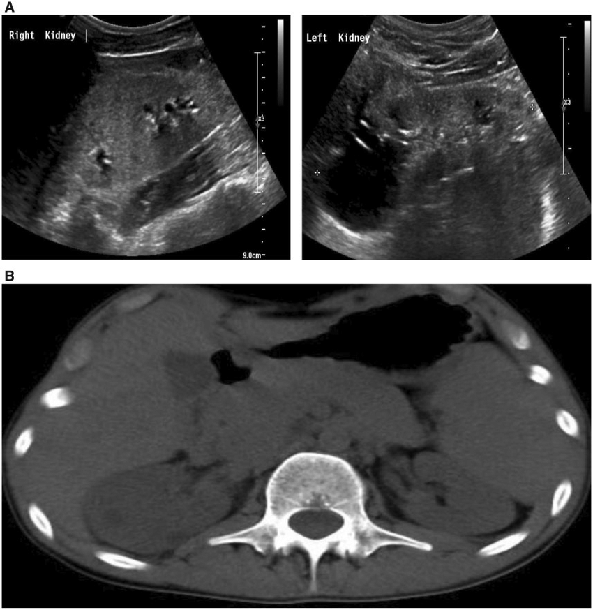 (A) Renal ultrasound reveals echogenic parenchyma with numerous small ...
