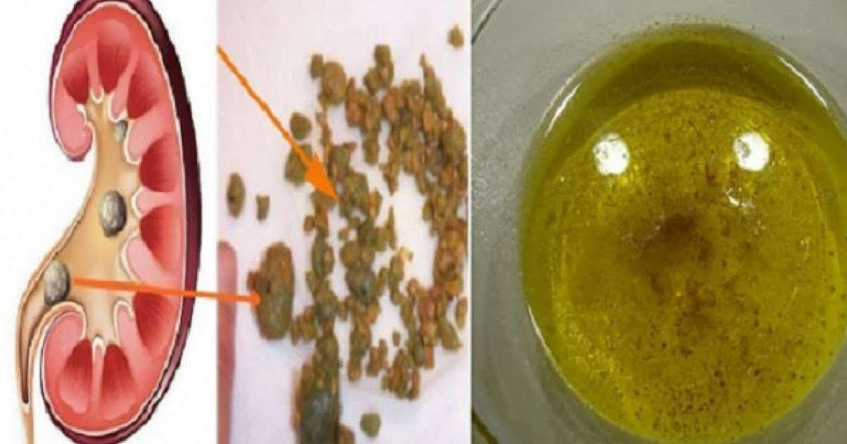 According To Expert: How To Pass Kidney Stones Quickly ...