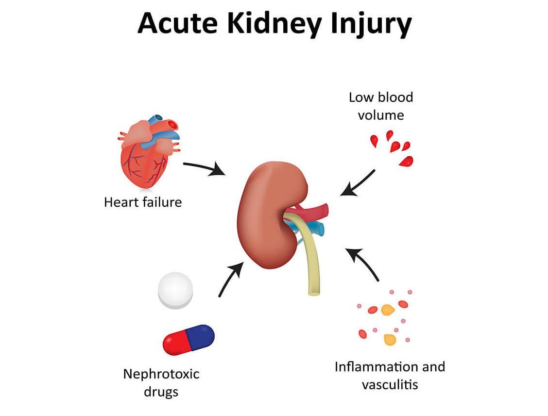 Acute Kidney Injury (AKI)  Kidney Failure News