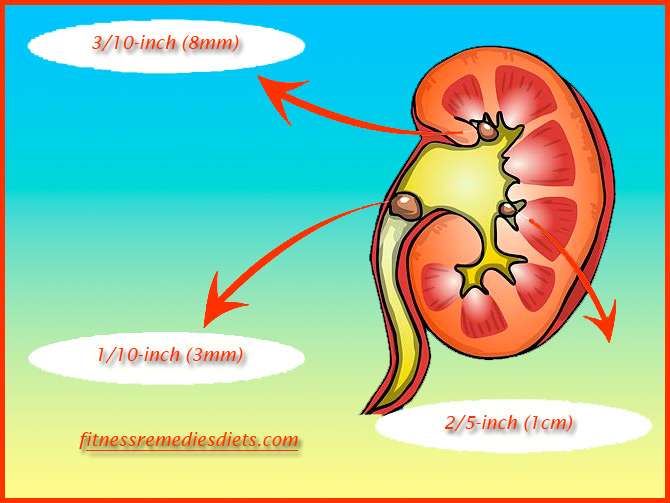 All You Need To know On How to Avoid Kidney Stone (Foods)