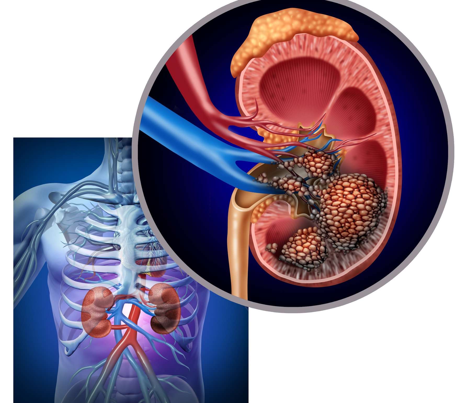 * An Overview of Kidney Cancer