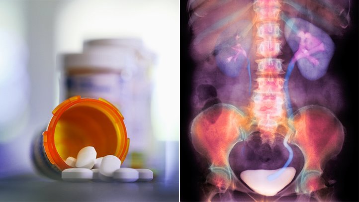 Antibiotics May Raise Kidney Stone Risk, Finds New Study ...