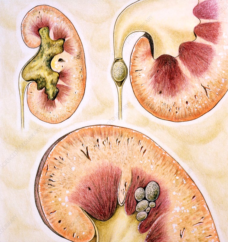 Artwork of different types of kidney stones