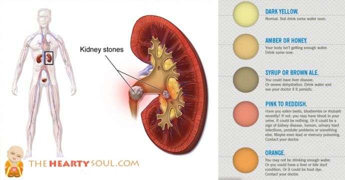 Can Blood In Urine Mean Kidney Stones