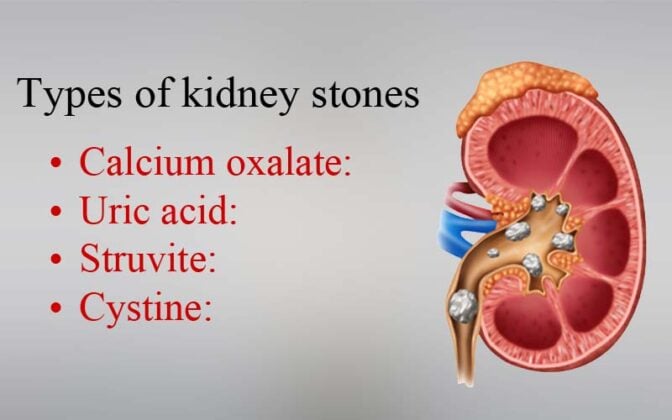 Can I play Football with Kidney Stones?