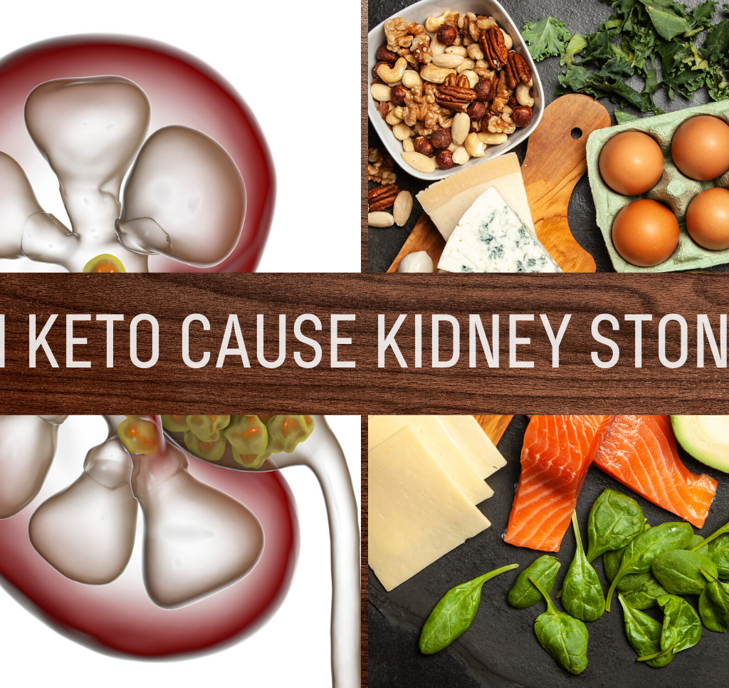 Can Keto Cause Kidney Stones?
