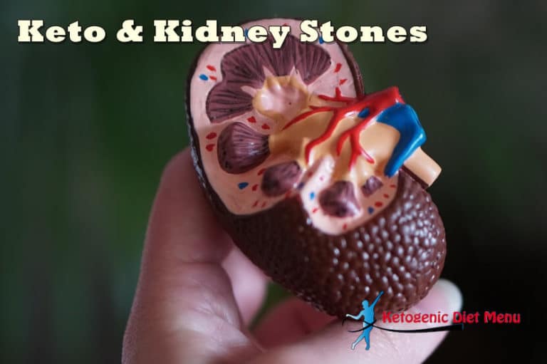 Can Keto Diet Cause Kidney Stones?
