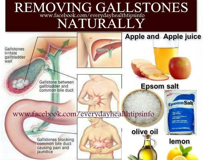 Can Kidney Stones Feel Like Gallstones