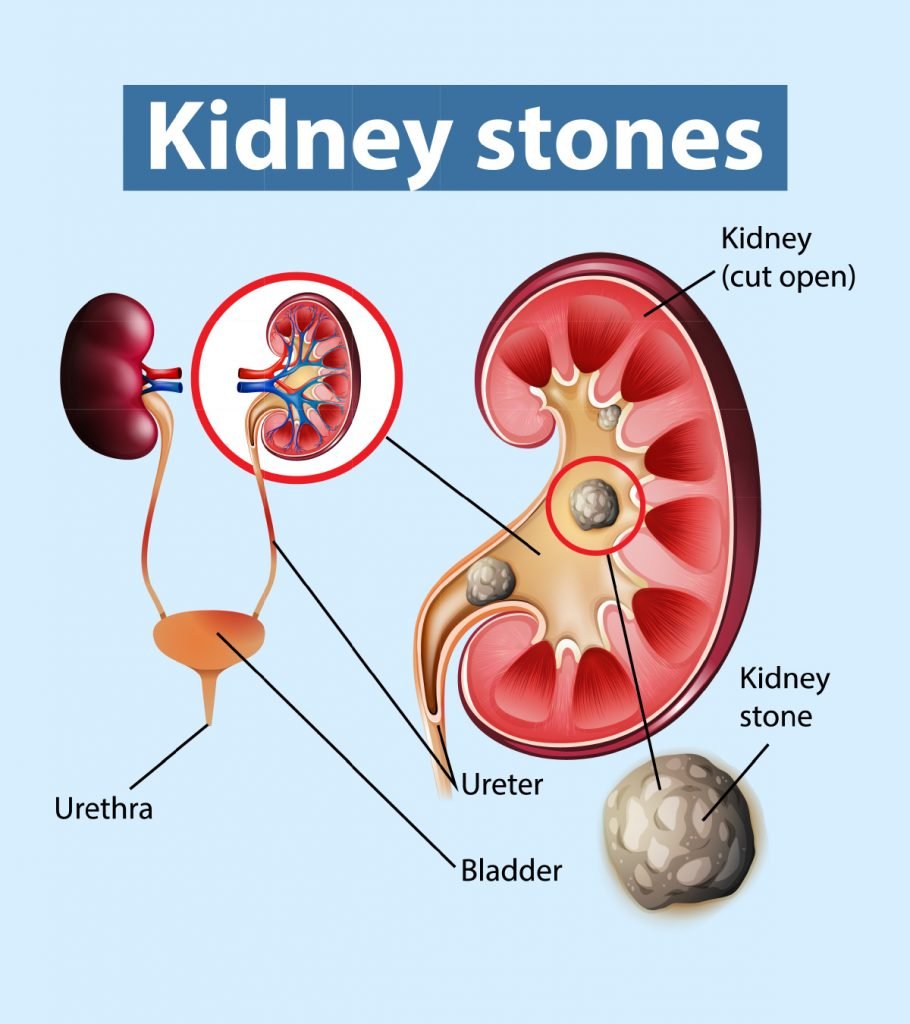 Can Teens Get Kidney Stones? Causes, Symptoms, And Treatment
