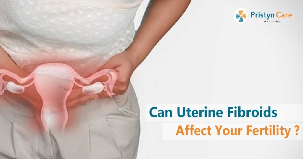 Can Uterine Fibroids Affect Your Fertility?