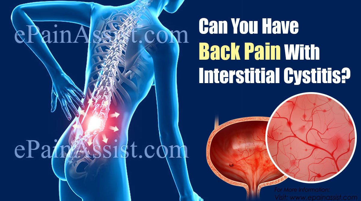 Can You Have Back Pain With Interstitial Cystitis &  Does ...