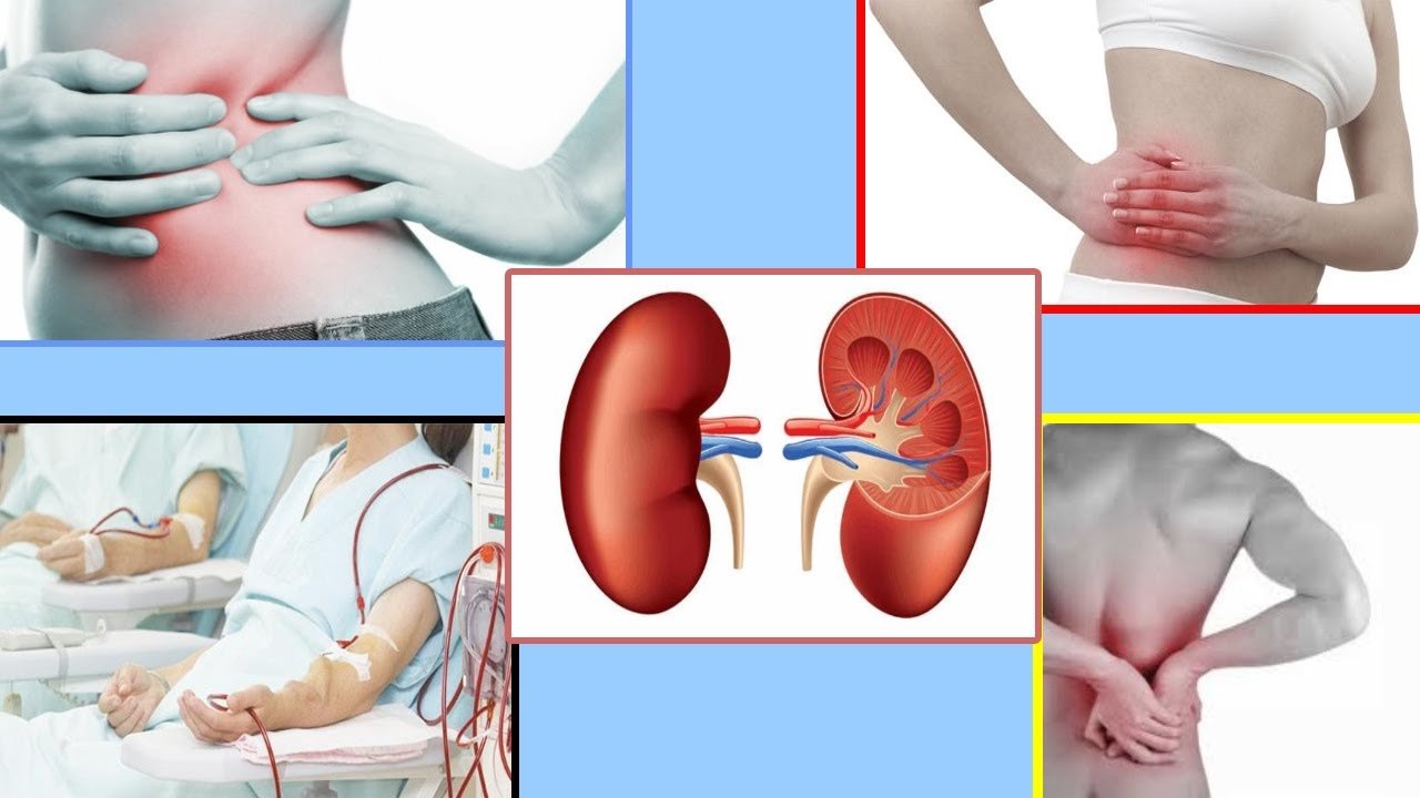 Chronic Kidney Disease ( pain, back pain, kidney stone ...