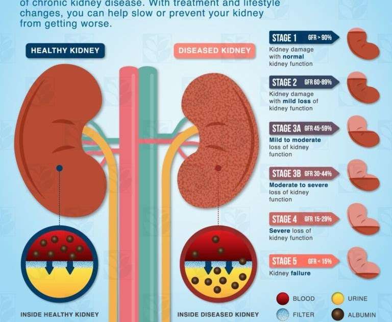 Chronic Kidney Failure Stages