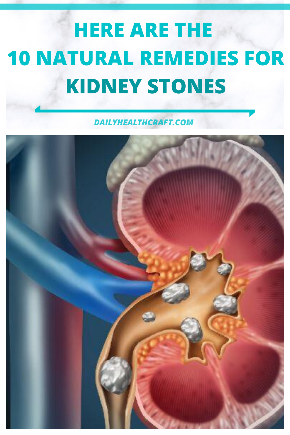 Click here to know the 10 natural remedies for kidney stones