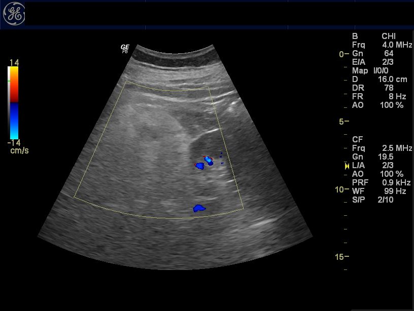 cochinblogs: Sonography of right renal mass: