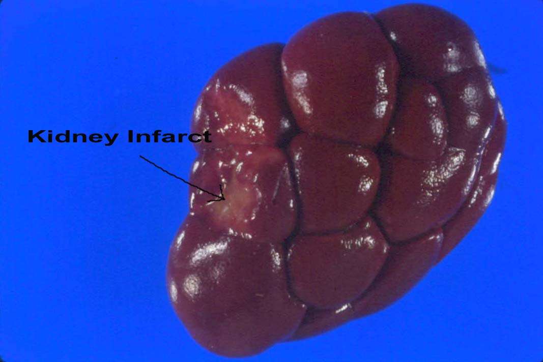 Common Kidney Lesions