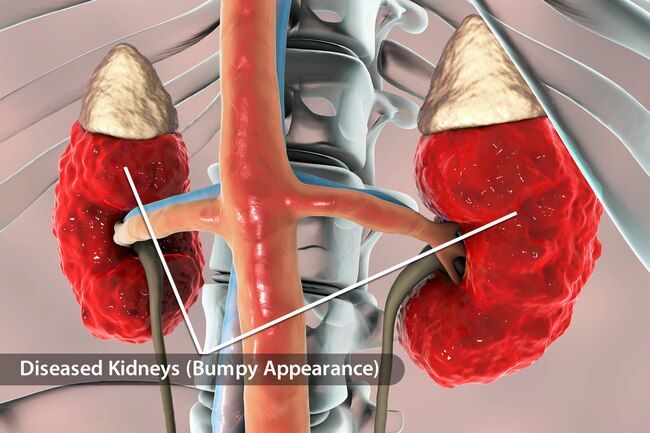 Conditions That Affect Your Kidneys