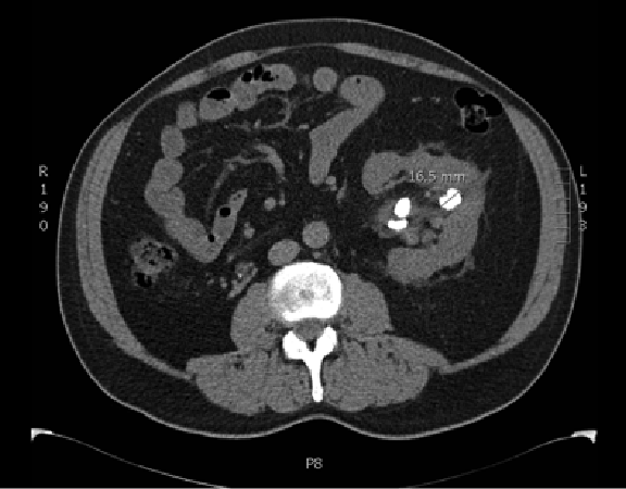 CT Scans Overused in Emergency Departments for Kidney ...