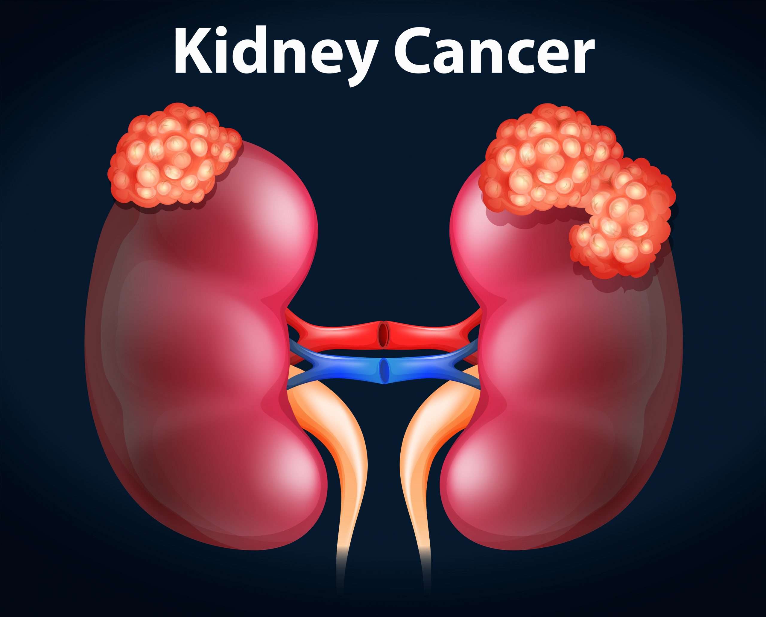 Diagram showing kidney cancer 297617 Vector Art at Vecteezy