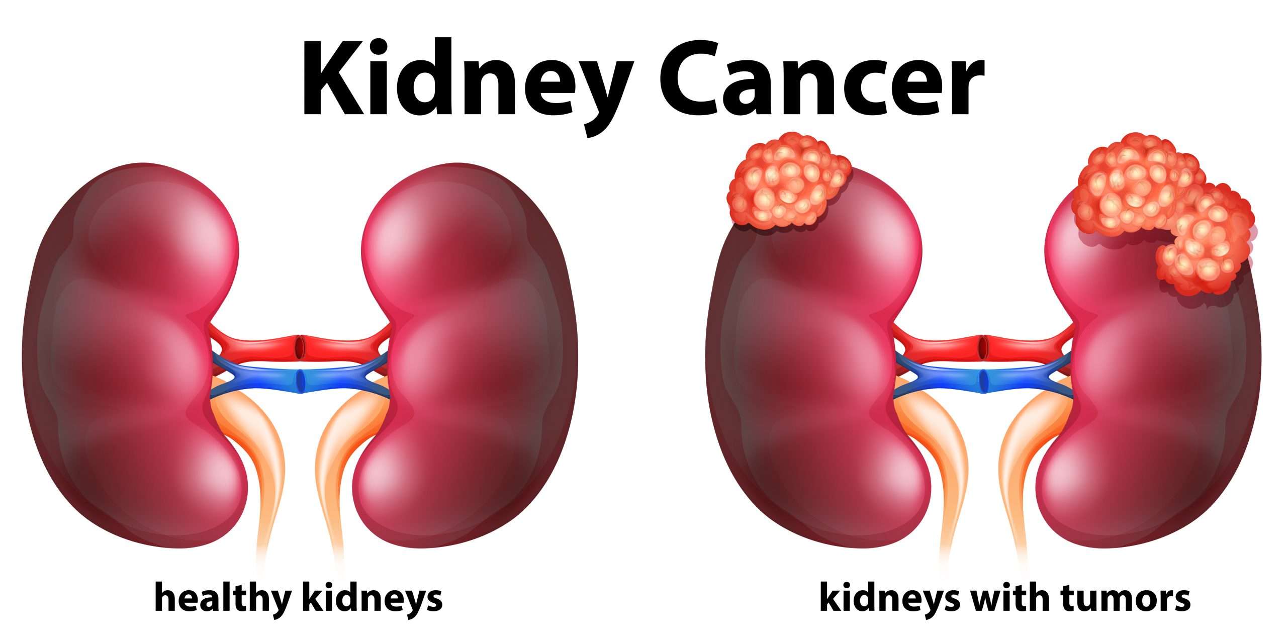 Diagram showing kidney cancer in human 295988 Vector Art at Vecteezy