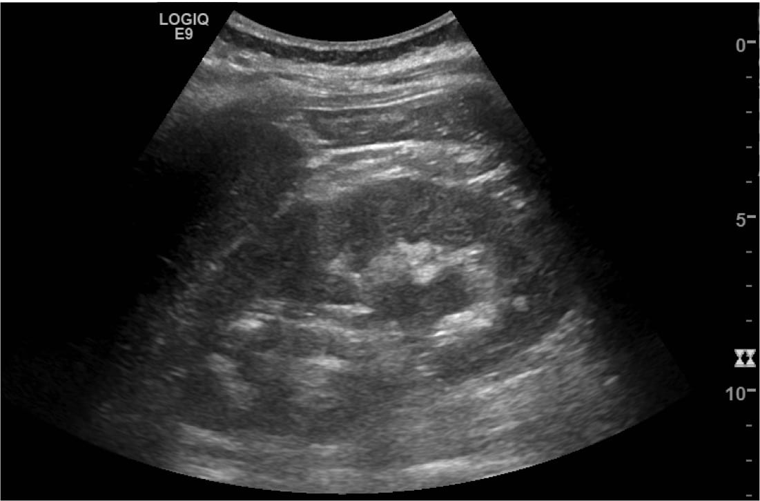 Distal VUJ stone: Case 2  LITFL  Ultrasound Clinical Cases