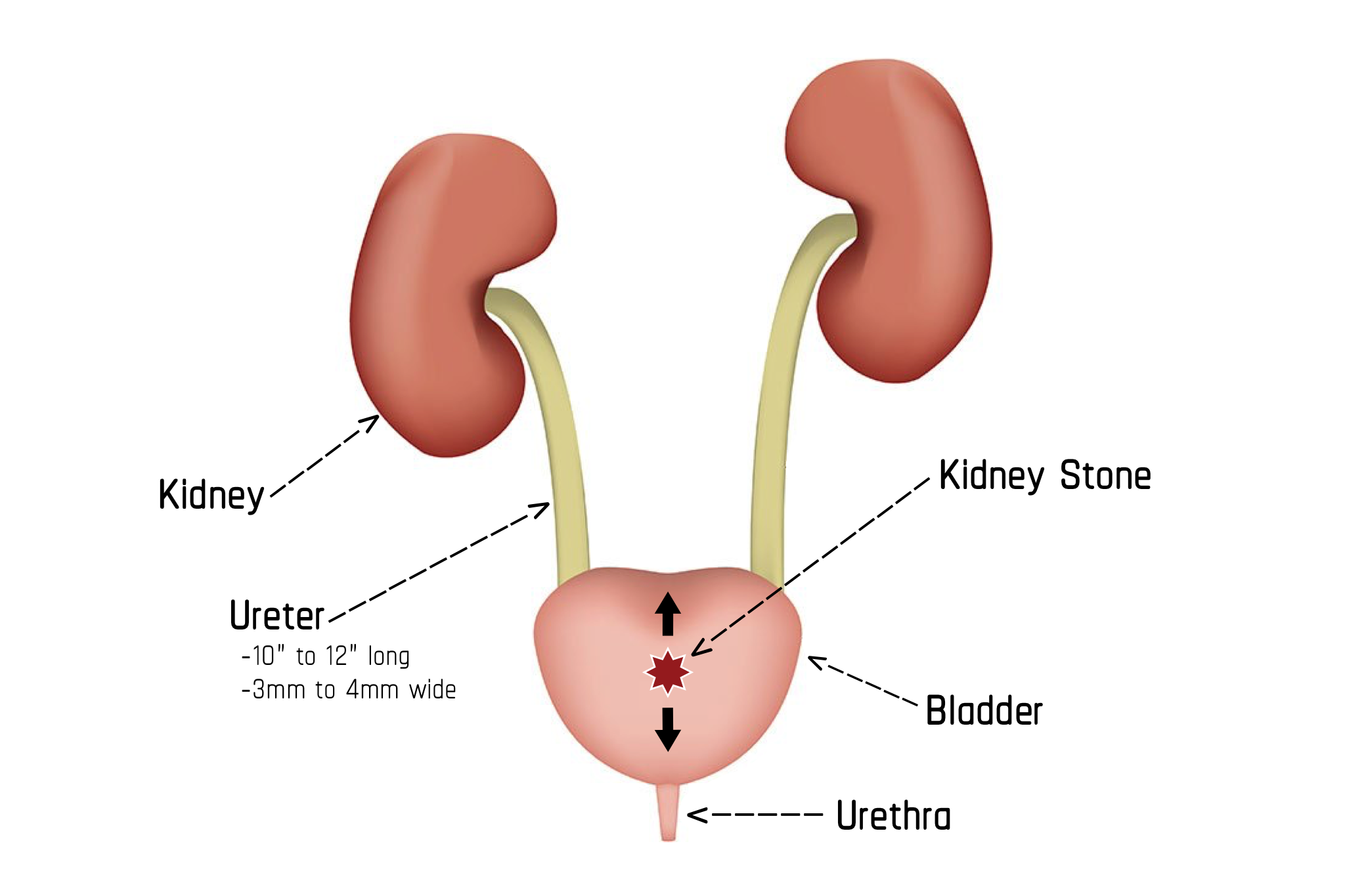 Does A Ureteral Stent Help Pass A Kidney Stone
