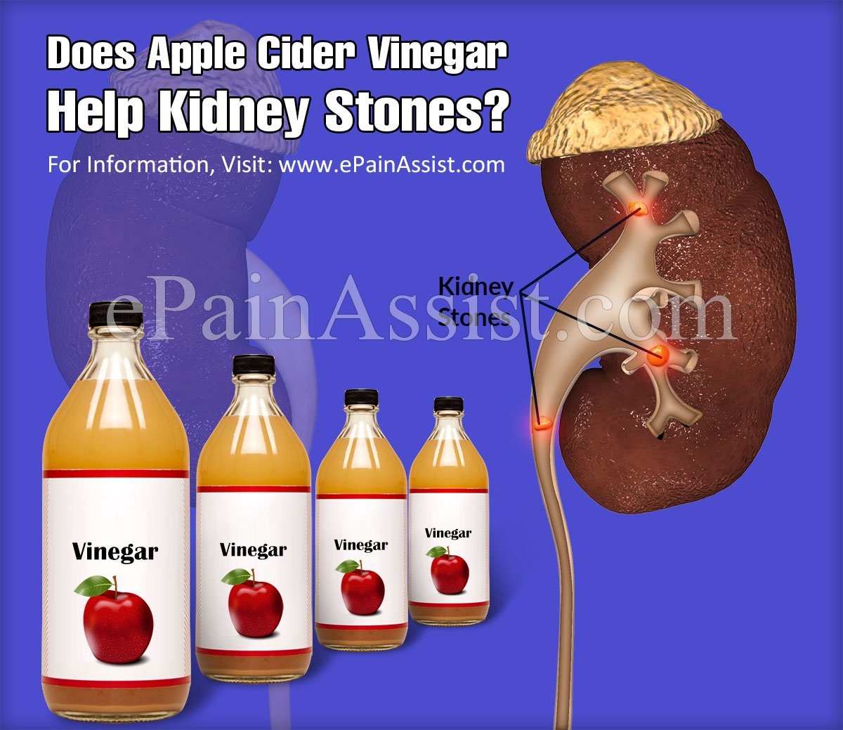 Does Apple Cider Vinegar help Kidney Stones?