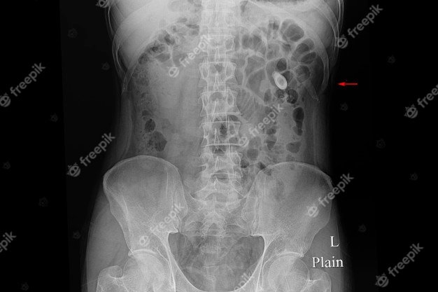 Does Kidney Stones Show Up On Xray