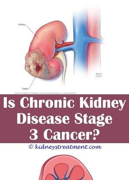 Early Stage 4 Kidney Cancer
