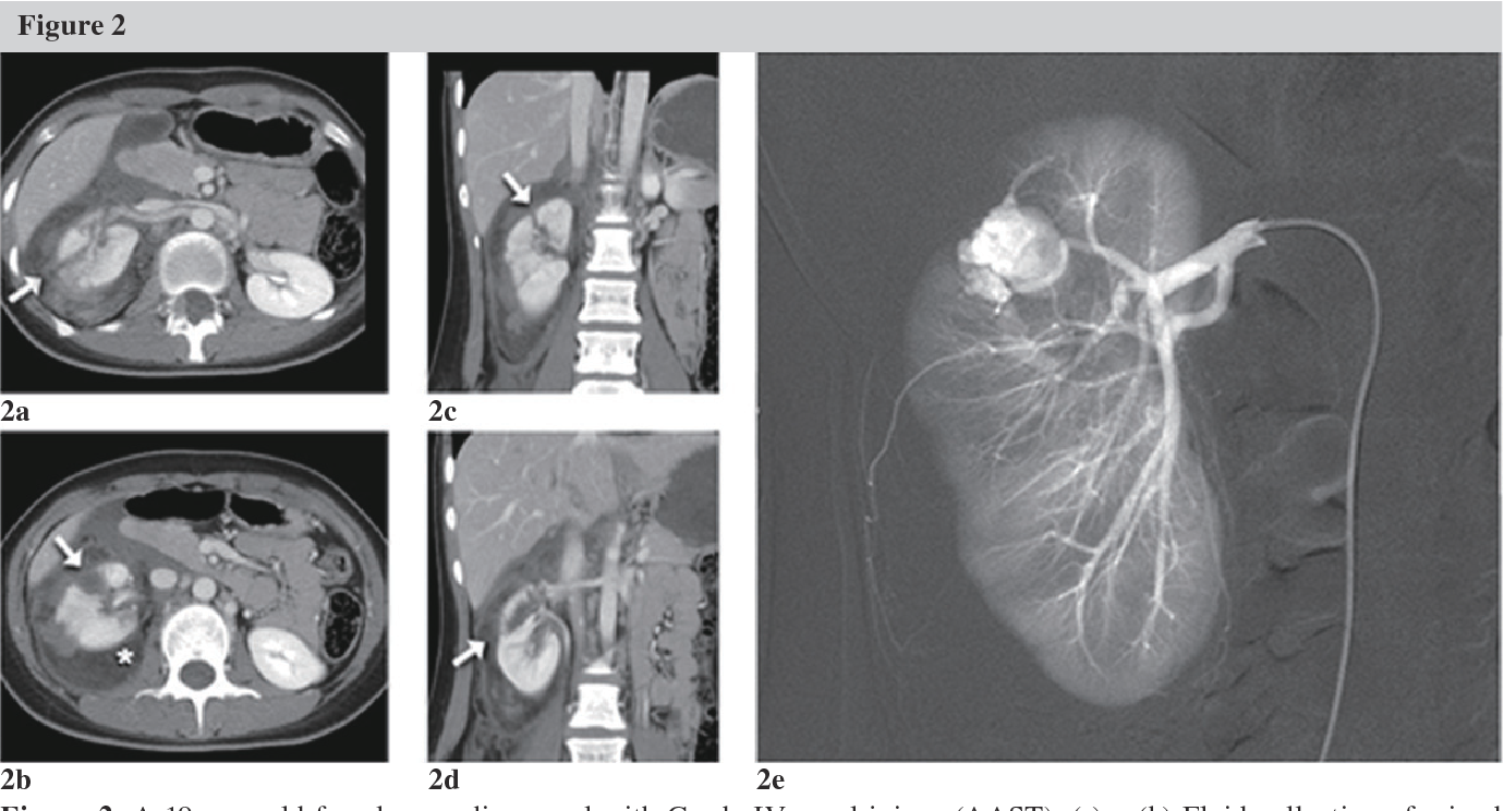 Figure 2 from Renal Artery Embolization in Patients with Blunt Renal ...