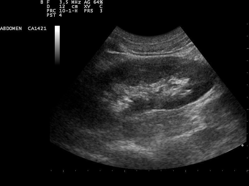 File:Kidney ultrasound 110304154307 1546020.jpg ...