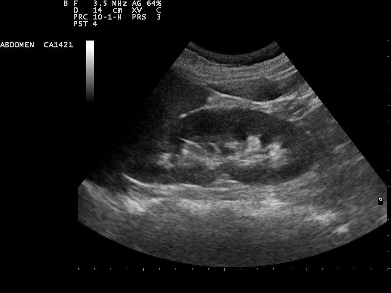 File:Kidney ultrasound 110315132820 1329070.jpg ...