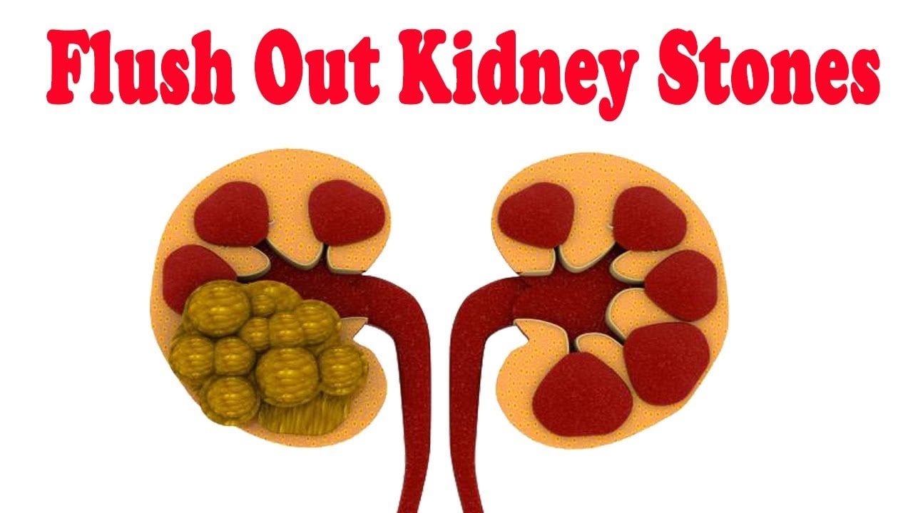 Flush out your Kidney Stones Instantly with this Natural ...