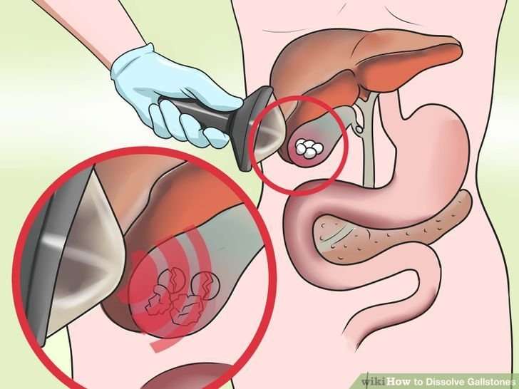 Gallstones and kidneystones  Steemit