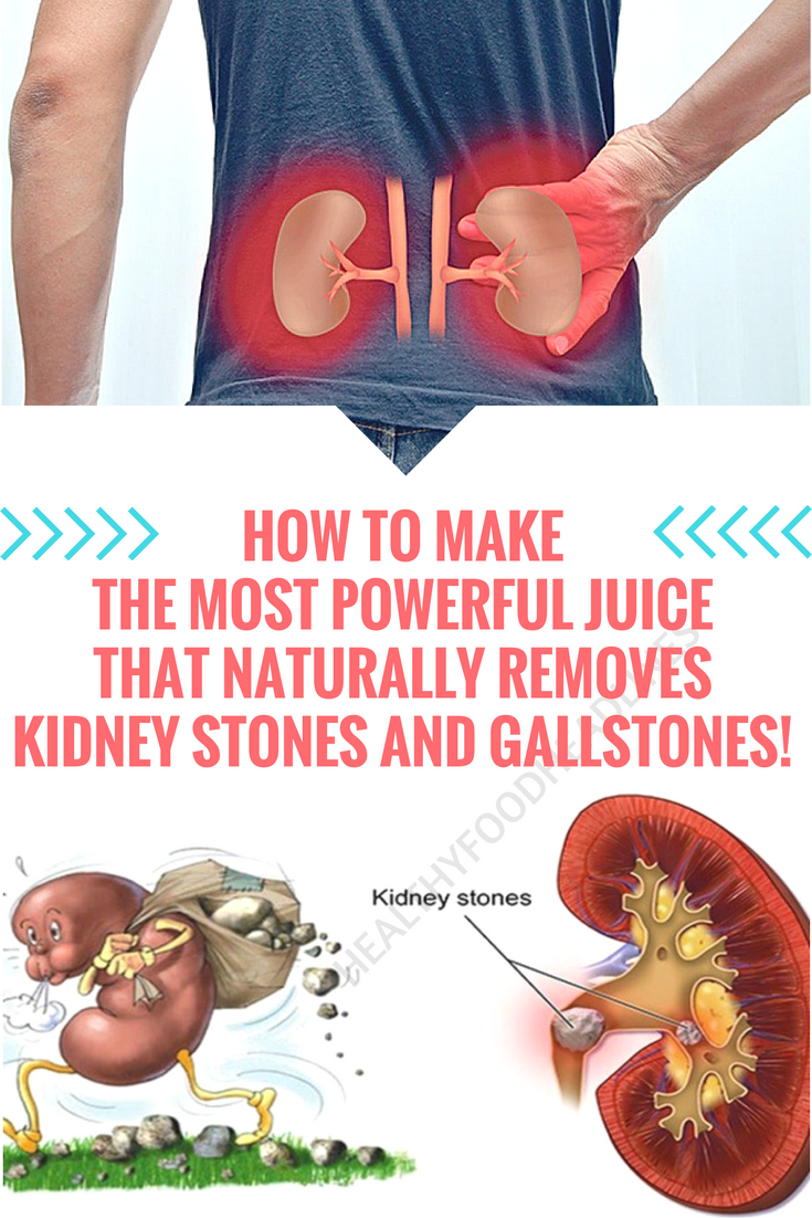 Gallstones Or Kidney Stones Pain