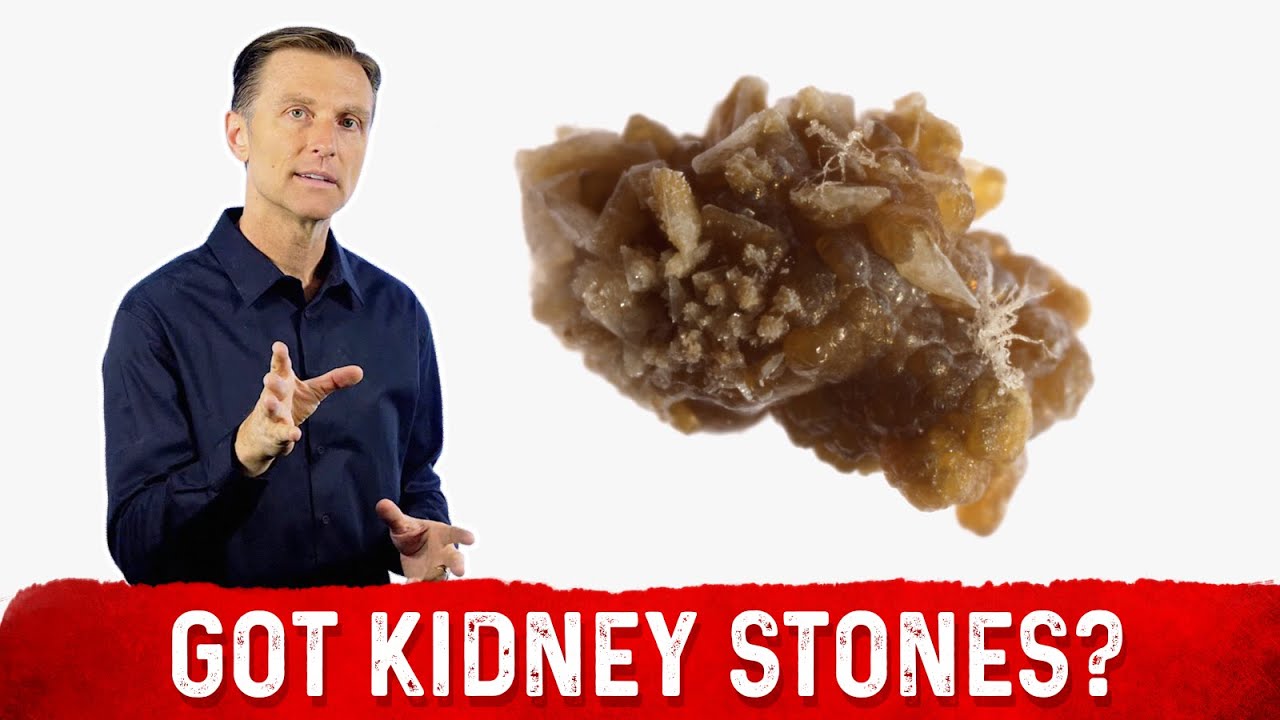 Got Kidney Stones?